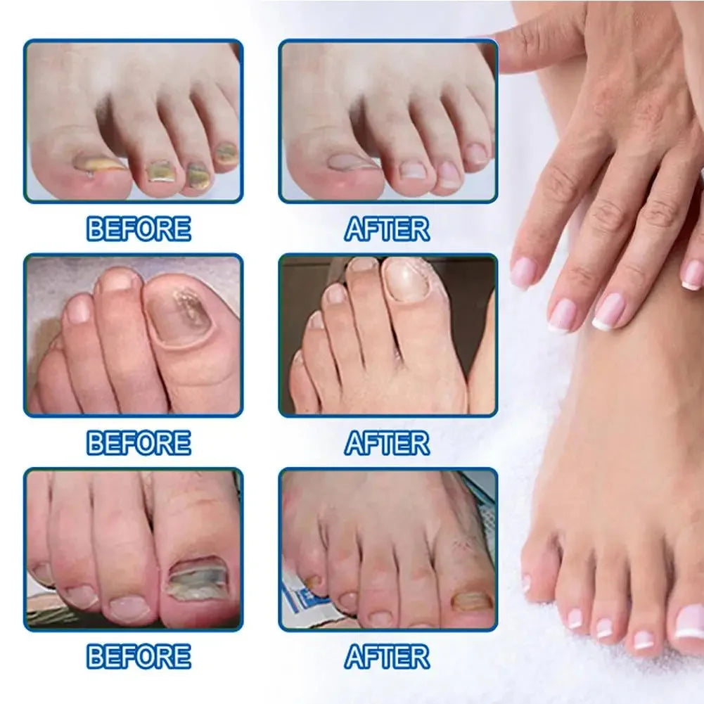 Discreet Fungal Nail Repair Patches — photo 5